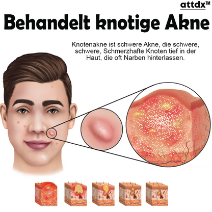 ATTDX Hautunreinheit Akne Jugend Serum