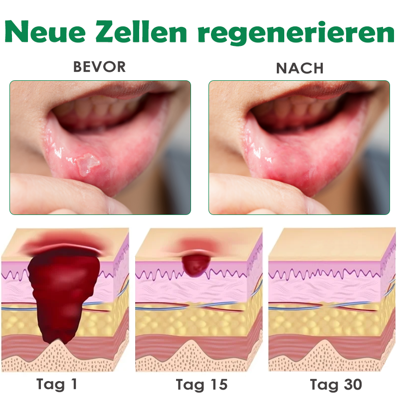 ATTDX Mundpflege Propolis GeschwürErleichterung Sprühen