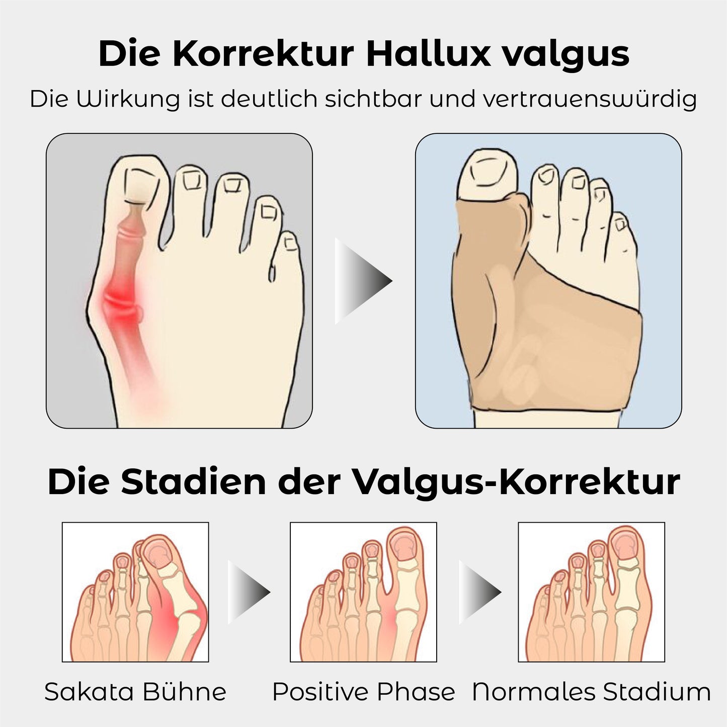 RICPIND 2 Hallux Harmonie Korrekturgurt mit Schutzärmeln