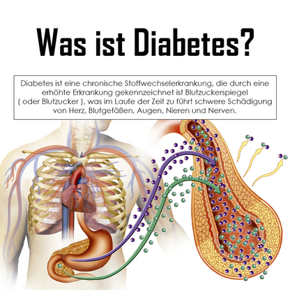 Ricpind ErleichterungZuckerkrankheit KörperBildhauerei HandRiemen