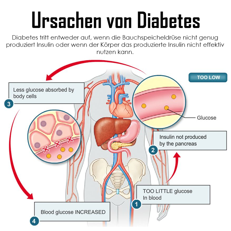 Ricpind ErleichterungZuckerkrankheit KörperBildhauerei HandRiemen