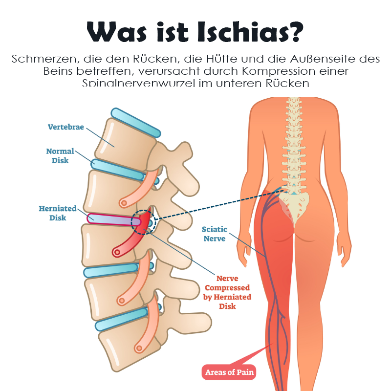 Ricpind SchmerzErleichterung IschiasTherapeutisch Kompression Gürtel